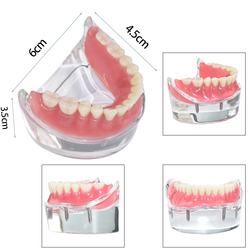 1 шт./упак. Зубной верхний протез Superior 4 имплантата Демонстрационная модель зубов Модель обучения студентов-стоматологов